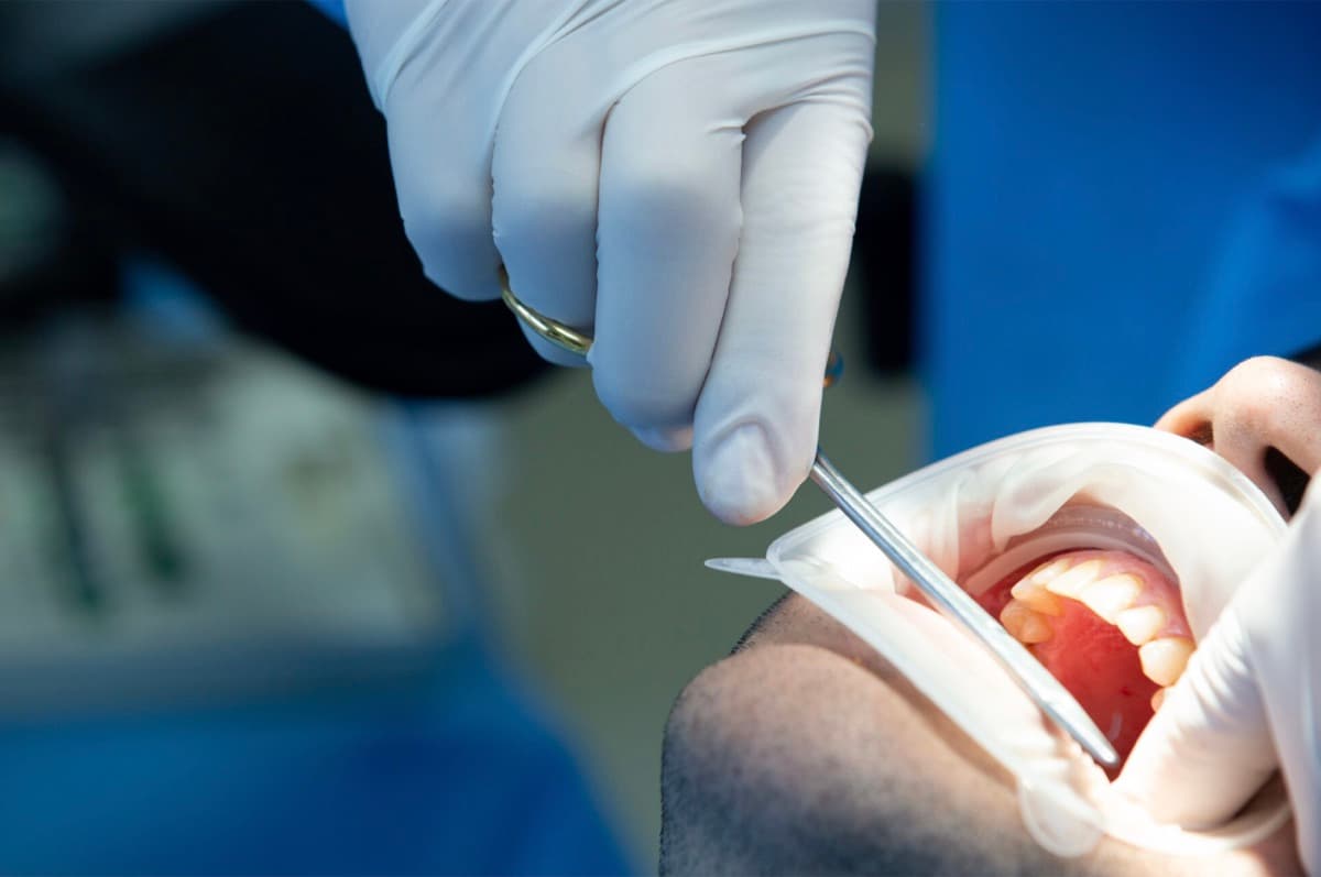 All-on-4 Bacău — extracții dentare sub anestezie locală și inserarea implanturilor în aceeași ședință la Chromatic Dental