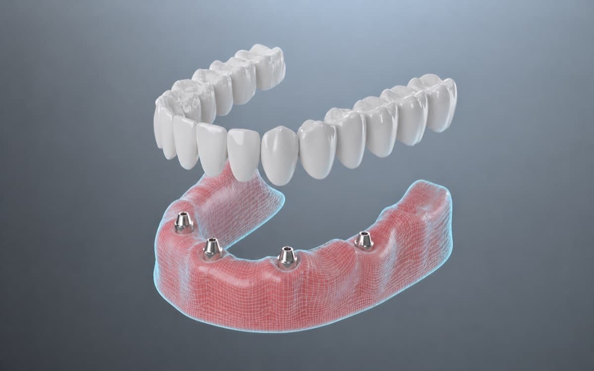 All-on-4 Bacău — schemă 3D a arcadei dentare ficse pe 4 implanturi, soluția pentru dinți ficși provizorii în 24-48 ore la Chromatic Dental