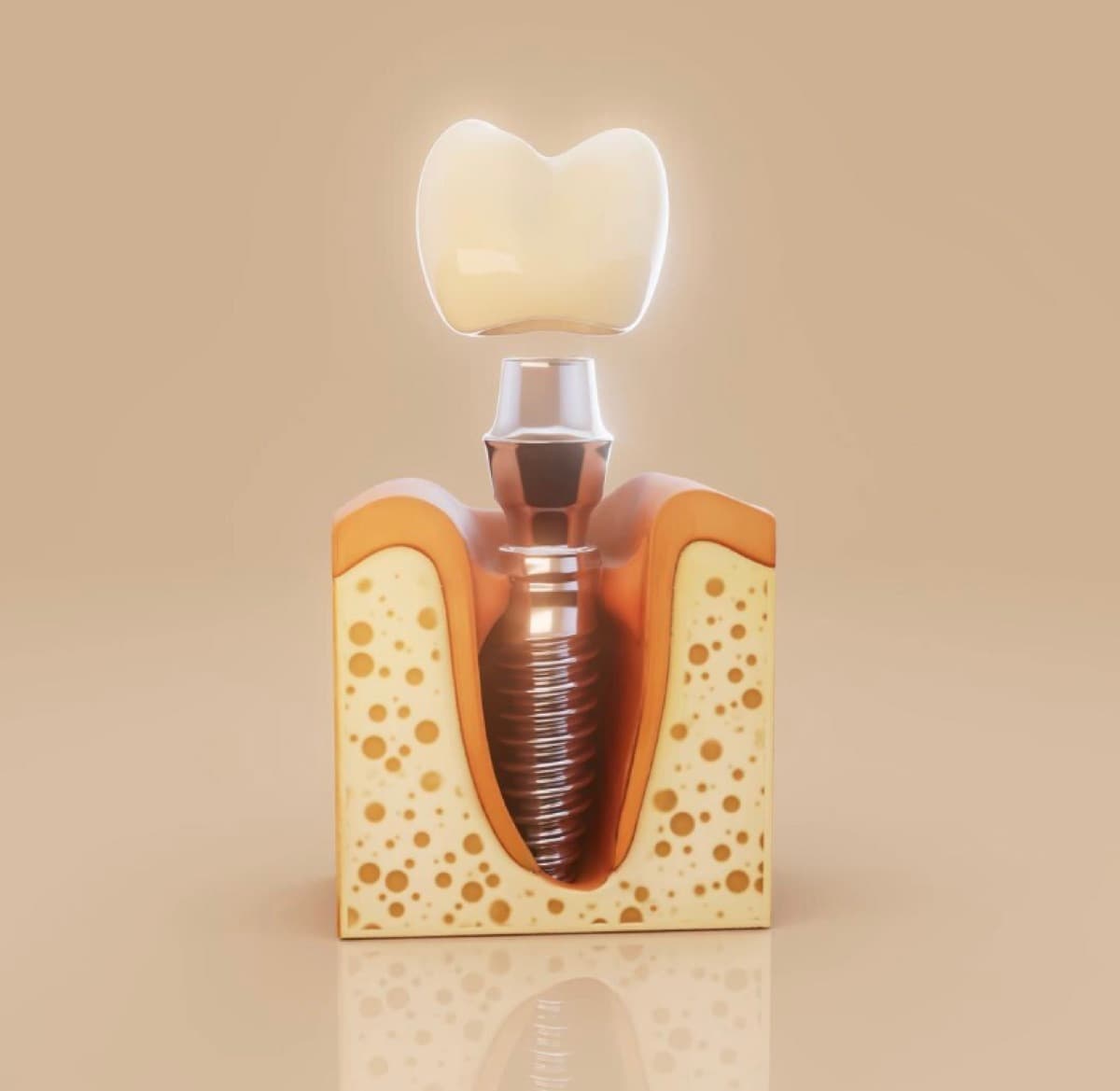 All-on-4 Bacău — secțiune 3D care arată osteointegrarea implantului dentar în os, etapa de vindecare la Chromatic Dental