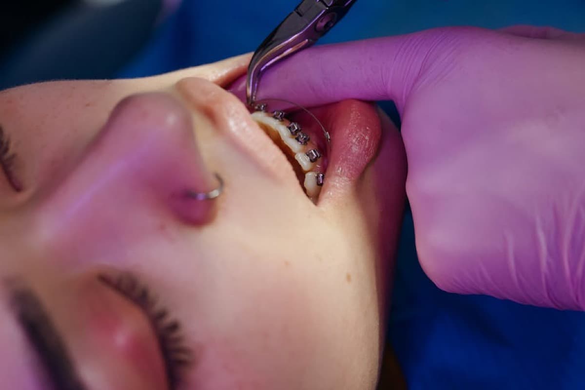 Cât costă un aparat dentar în Bacău