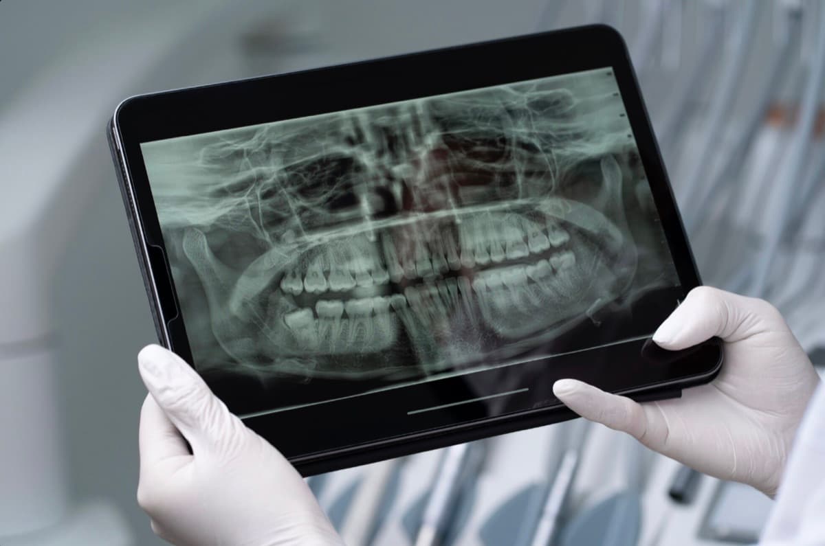 CBCT 3D pentru implant dentar Bacău — tomografie digitală pe tabletă pentru planificarea cazurilor complexe