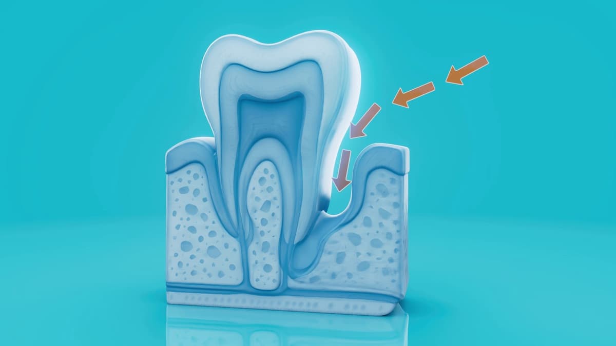 Ilustrație pungă parodontală și chiuretaj subgingival pentru parodontoză la Chromatic Dental Bacău