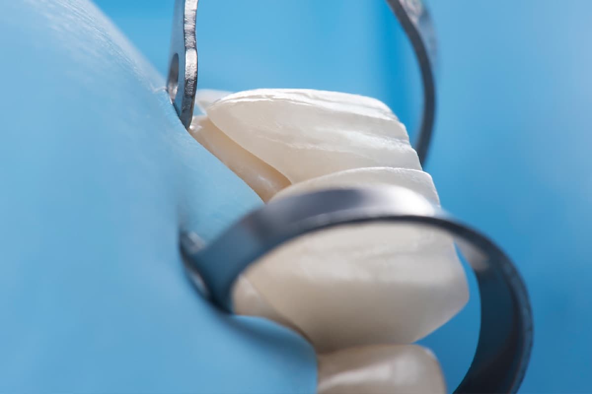 Fațete dentare Bacău — prepararea minimal invazivă a smalțului dentar pentru aplicarea fațetelor ceramice la Chromatic Dental