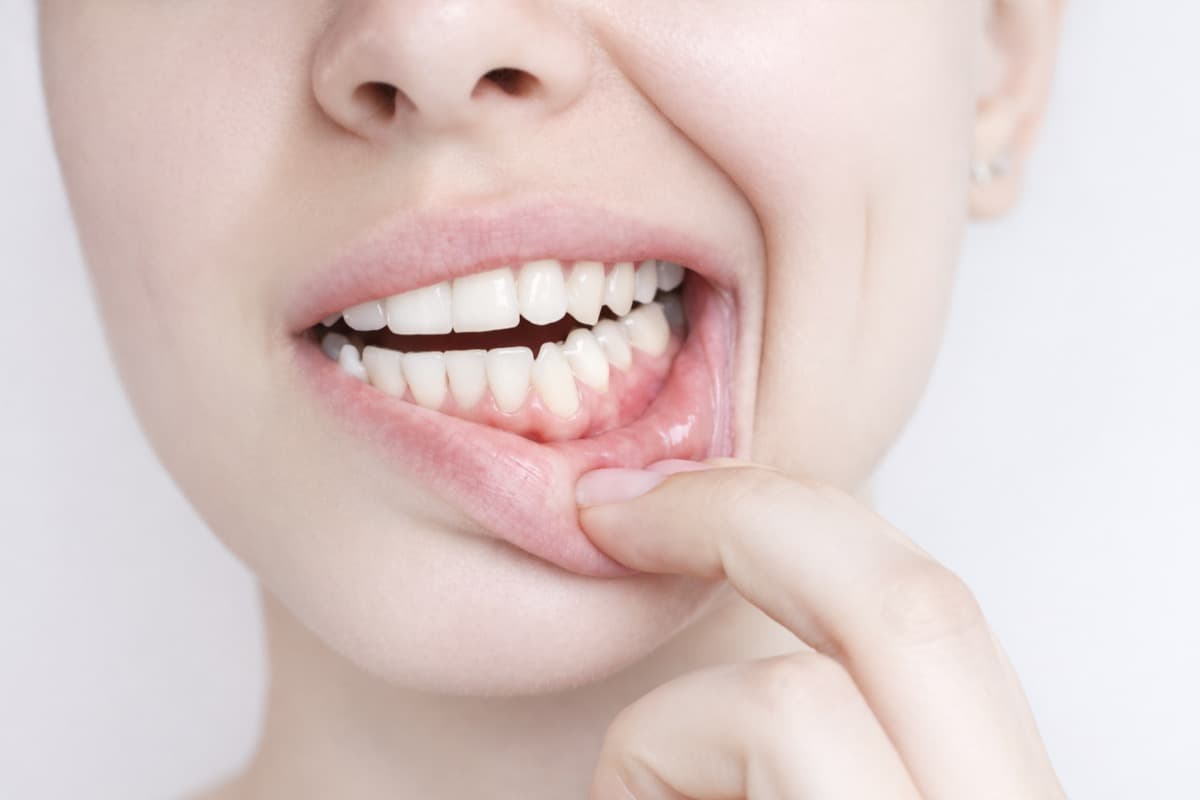 Semne de gingie inflamată ușor Bacău — pacientă care își trage buza pentru a-și verifica gingia roz, ușor umflată, fără durere — primul stadiu de gingivită diagnosticat la Chromatic Dental Clinic