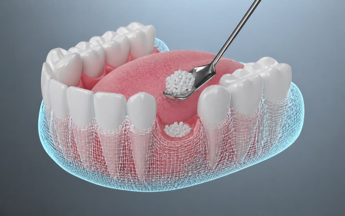 Grefă osoasă dentară Bacău — augmentare osoasă cu material regenerator în zona implantului