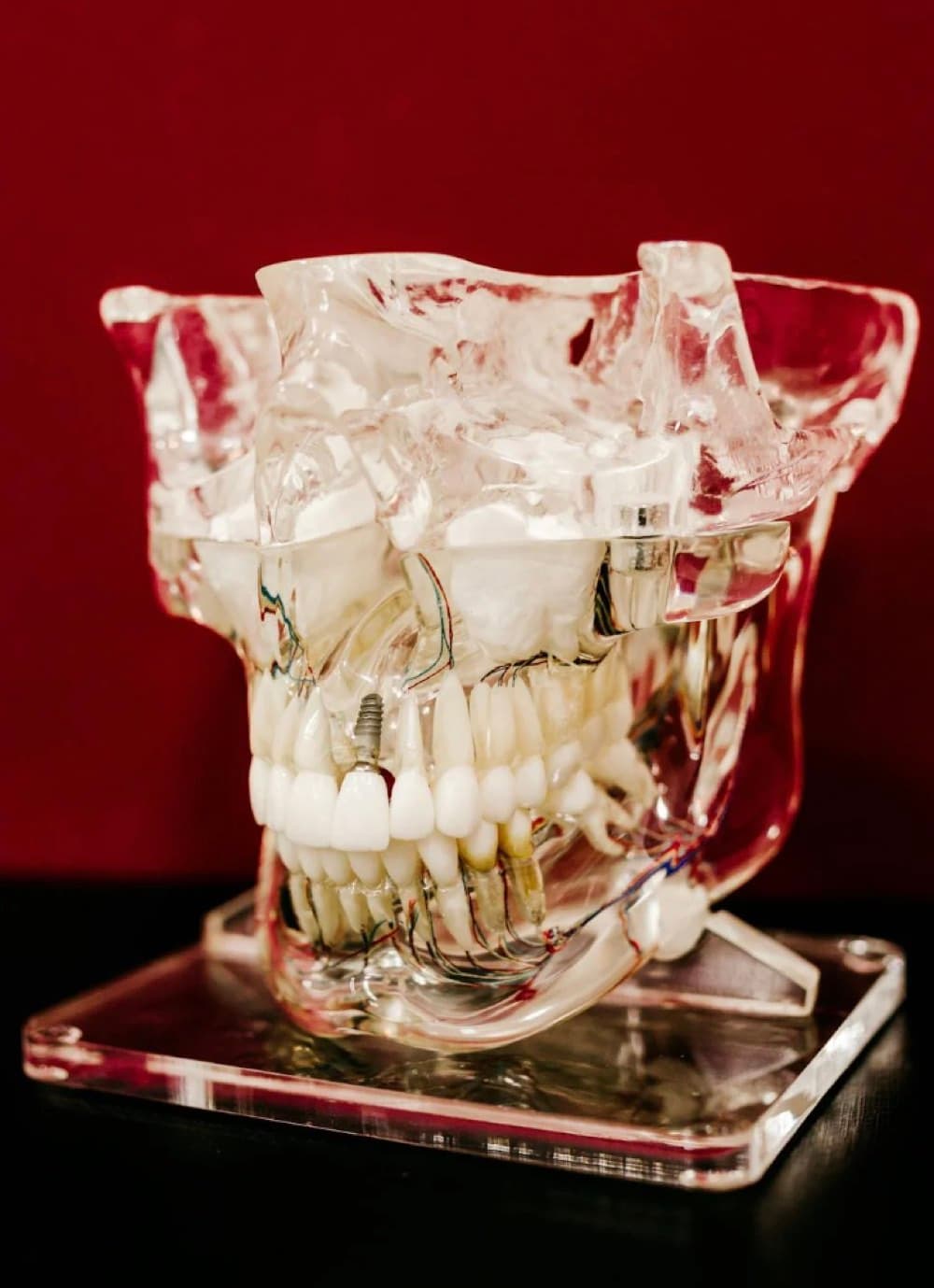 Cât rezistă un implant dentar Bacău — model anatomic transparent al maxilarului cu un implant dentar din titan integrat în os la Chromatic Dental Clinic