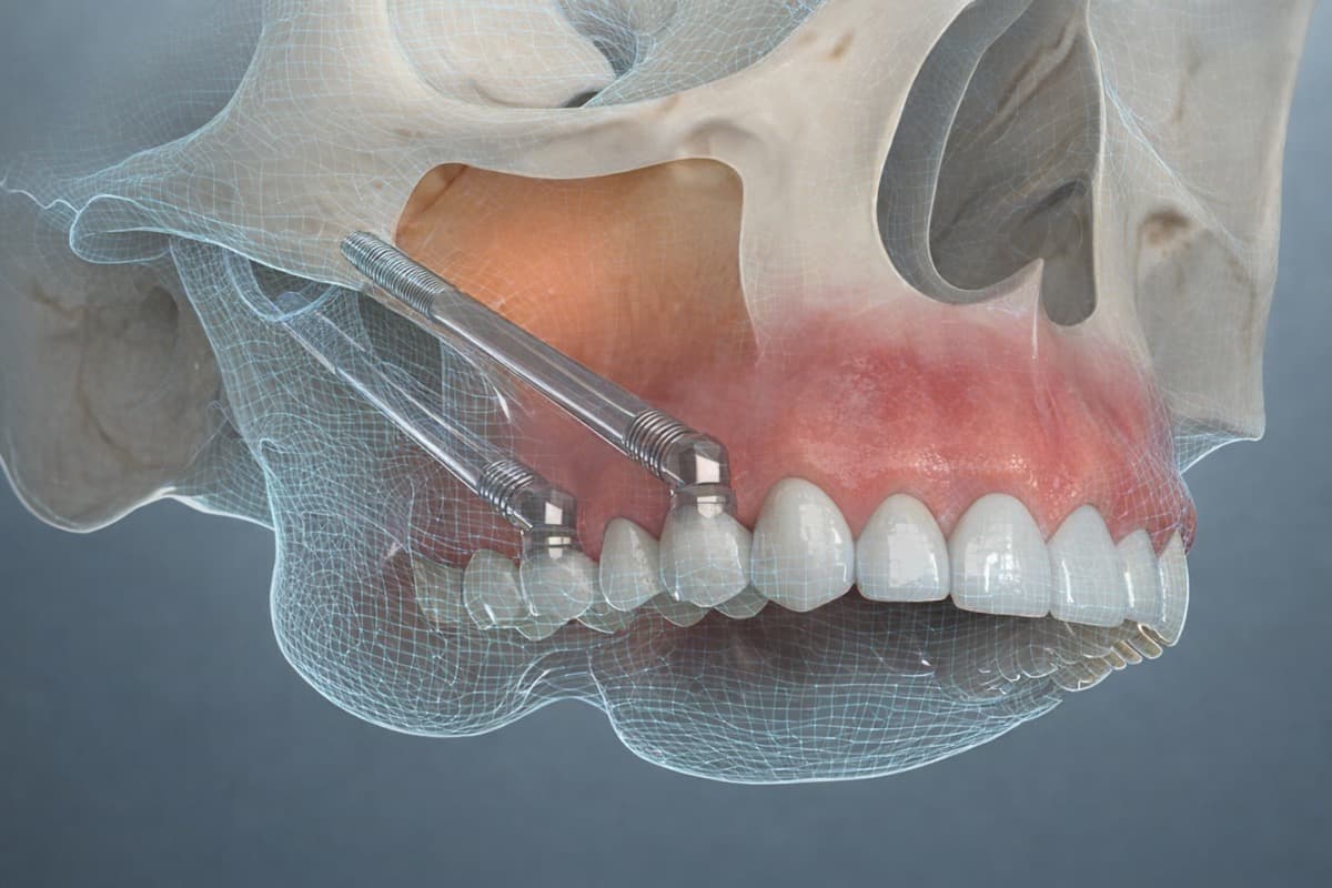 Implant zigomatic Bacău — implanturi lungi ancorate în osul zigomatic pentru atrofie maxilară severă