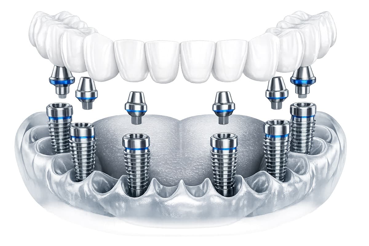Lucrare fixă pe implanturi Bacău — randare 3D a unei arcade complete cu 6 implanturi din titan în os și lucrarea protetică fixă tip All-on-6 deasupra, la Chromatic Dental Clinic