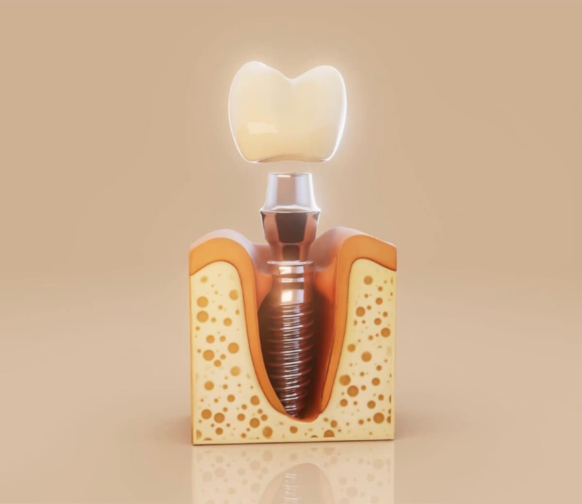 Implant dentar cu os insuficient Bacău — secțiune transversală cu implantul fixat în os și coroana de deasupra