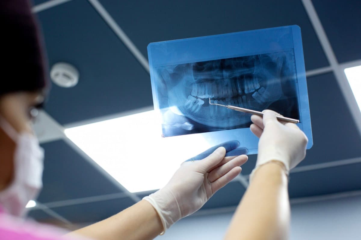 Radiografie panoramică pentru implant dentar Bacău — medic stomatolog evaluează volumul osos pe imagistică digitală