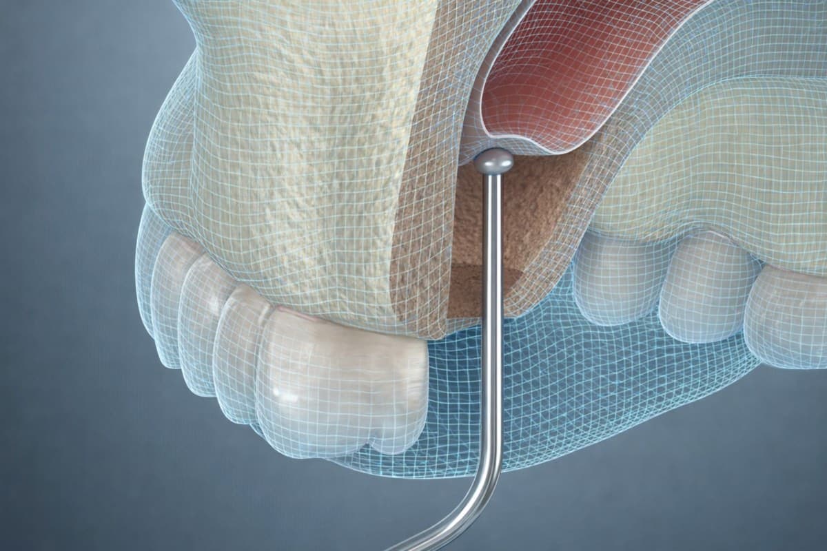 Sinus lift procedură Bacău — vizualizare anatomică a ridicării membranei sinusului maxilar și adăugării de os