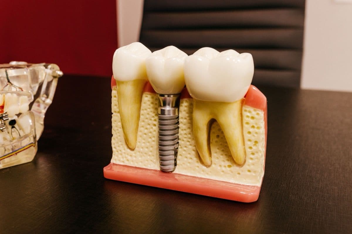Coroană pe implant Bacău: model cu implant, bont și coroană la Chromatic Dental Clinic