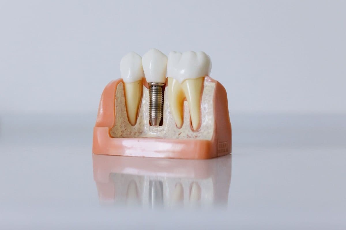 Model cu implant imediat fixat în os între doi dinți naturali, folosit la consultațiile din Bacău