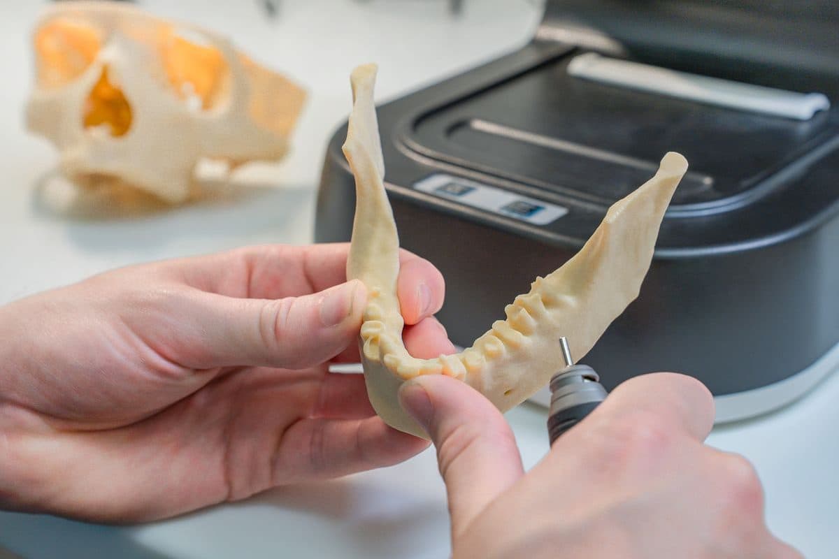 Model 3D printat al maxilarului, folosit la planificarea chirurgiei ghidate pentru implant în Bacău