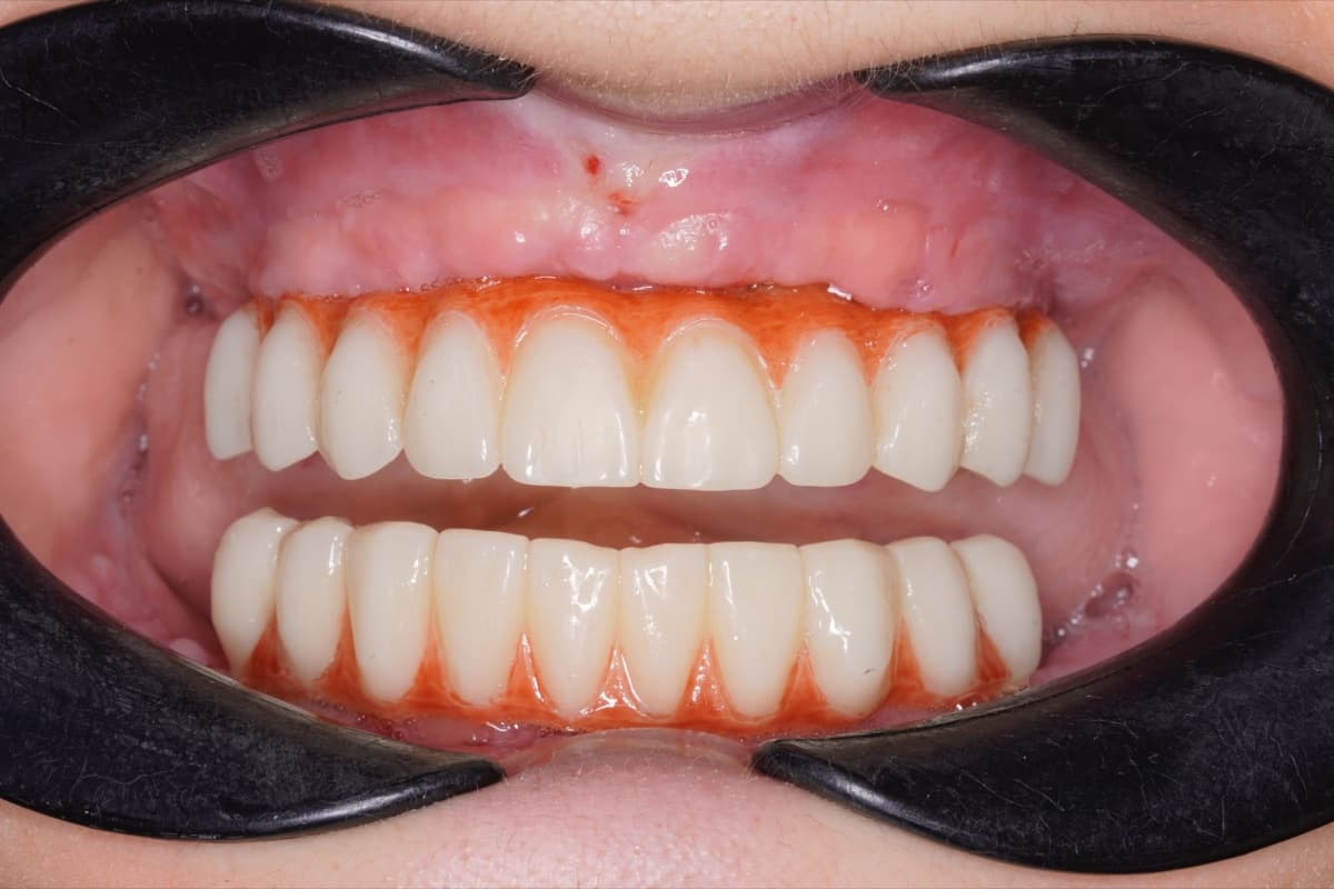 All-on-6 cu dinți ficși — tratament efectuat la Chromatic Dental Bacău