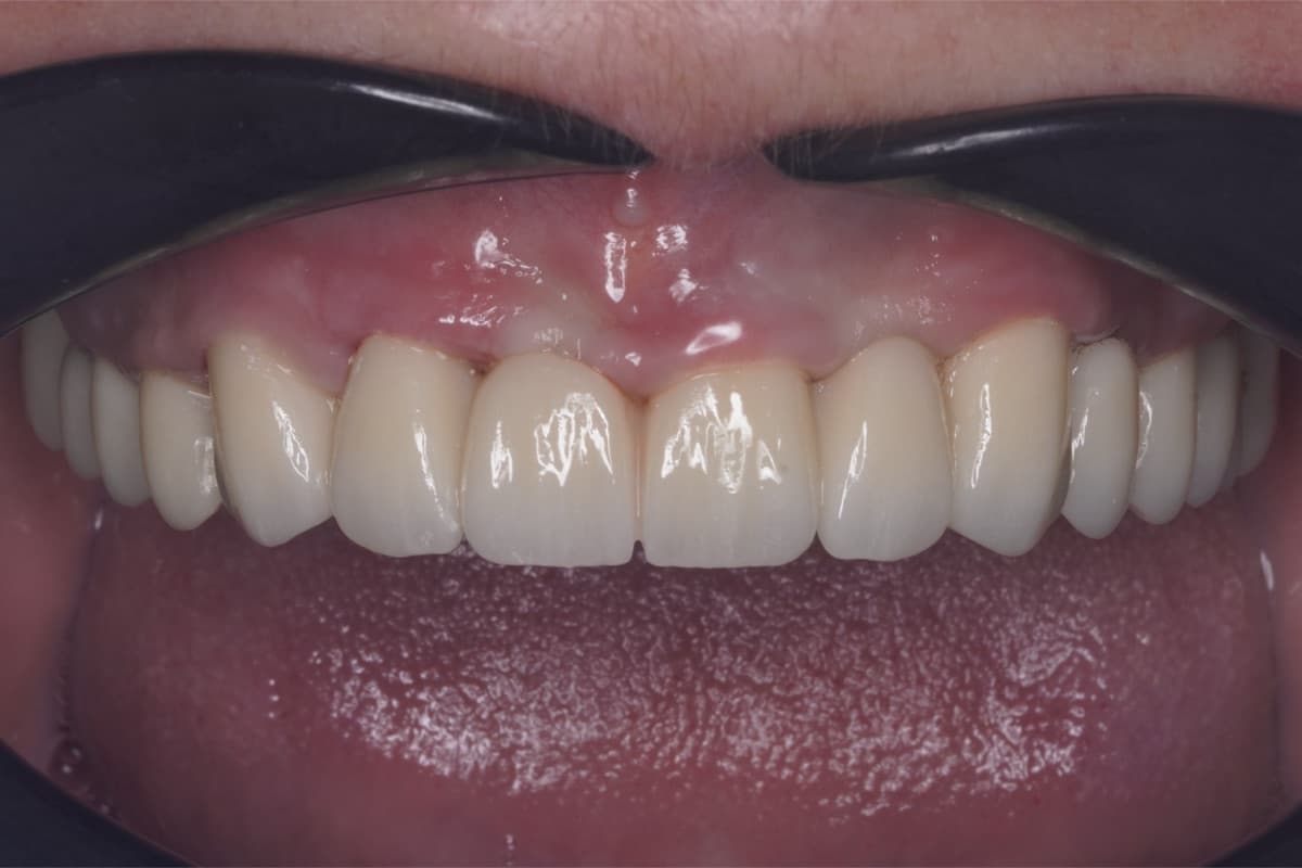 Coroane pe implanturi — tratament efectuat la Chromatic Dental Bacău