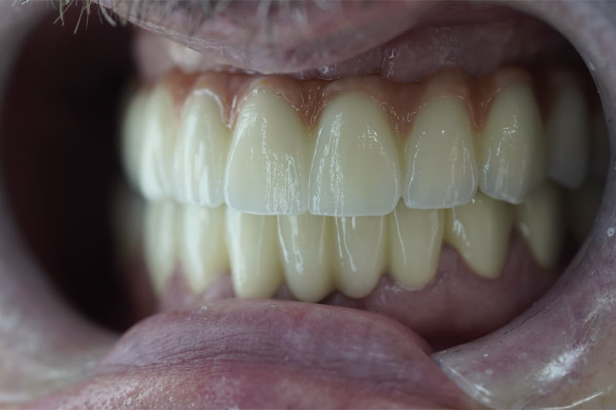 Coroane din zirconiu — tratament efectuat la Chromatic Dental Bacău