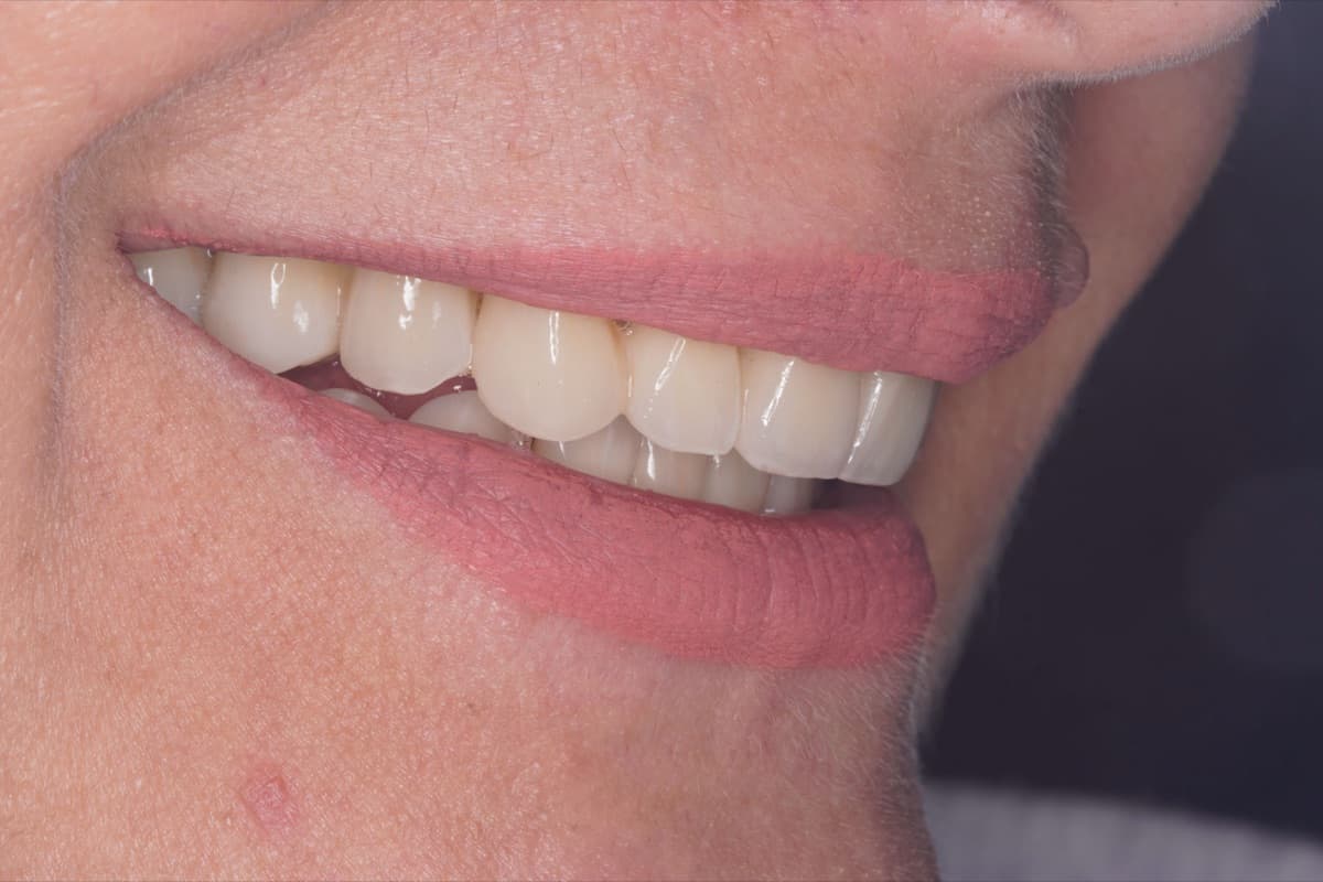Dinți ficși pe implanturi — tratament efectuat la Chromatic Dental Bacău