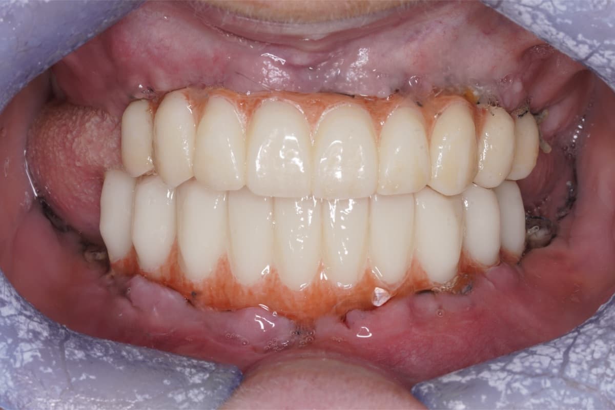 Dinți ficși din zirconiu — tratament efectuat la Chromatic Dental Bacău