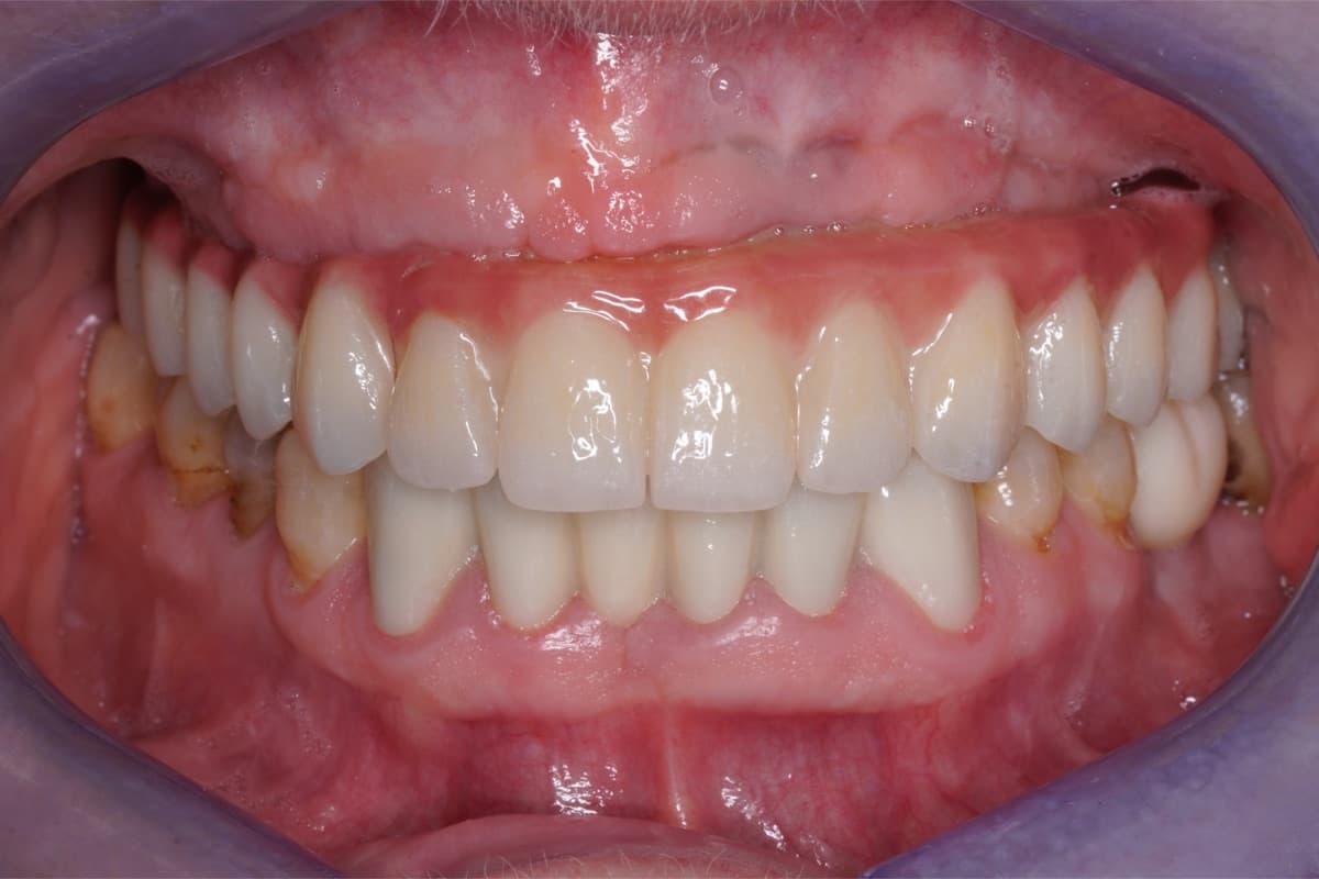 Estetică dentară pe implant — tratament efectuat la Chromatic Dental Bacău