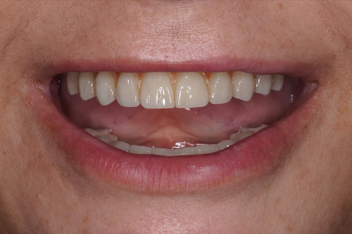 Fațete ceramice — tratament efectuat la Chromatic Dental Bacău