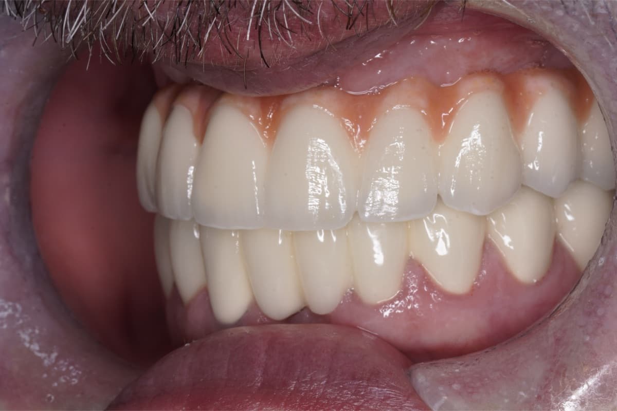 Proteză fixă pe implanturi — tratament efectuat la Chromatic Dental Bacău