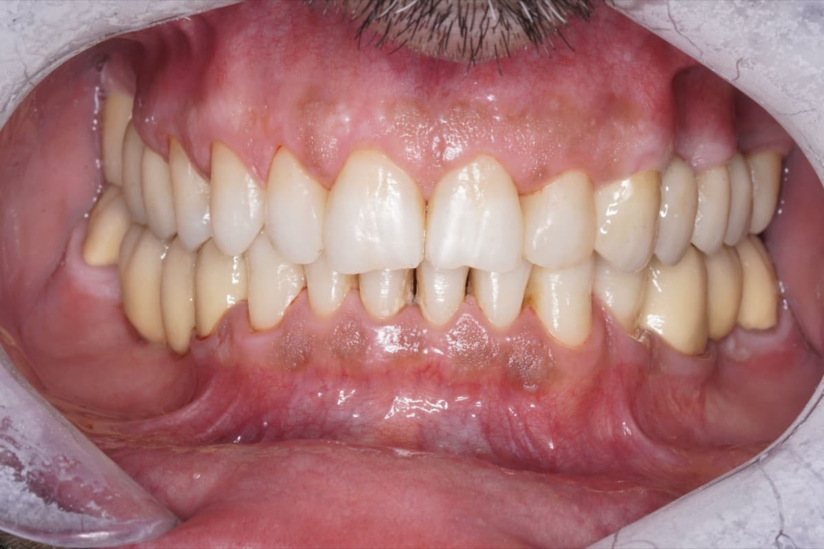 Punte pe implanturi — tratament efectuat la Chromatic Dental Bacău