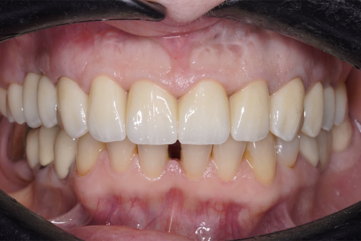 Reabilitare arcadă completă — tratament efectuat la Chromatic Dental Bacău