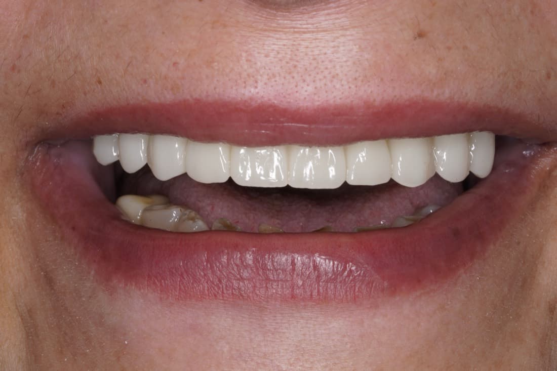Reabilitare completă pe implanturi — tratament efectuat la Chromatic Dental Bacău