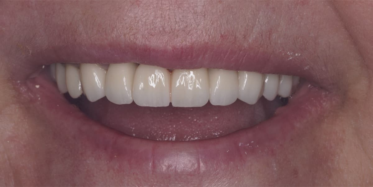 Reabilitare cu dinți ficși — tratament efectuat la Chromatic Dental Bacău