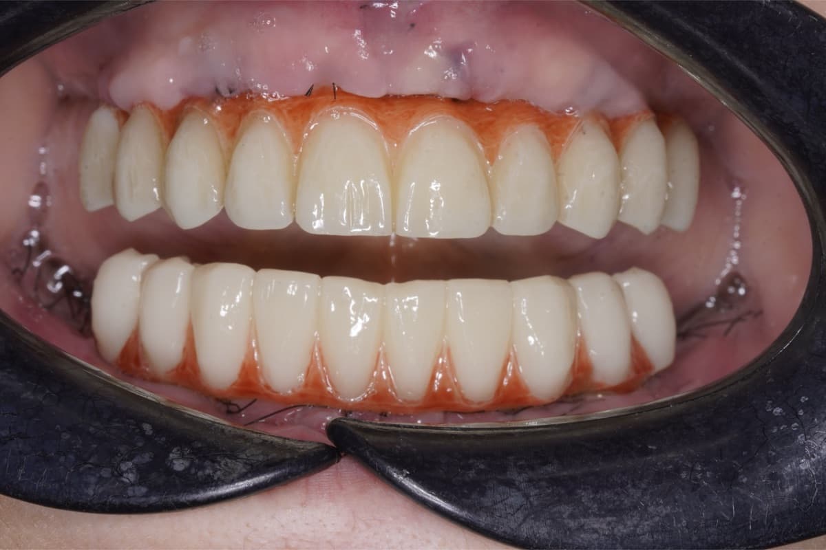 Reabilitare orală completă — tratament efectuat la Chromatic Dental Bacău