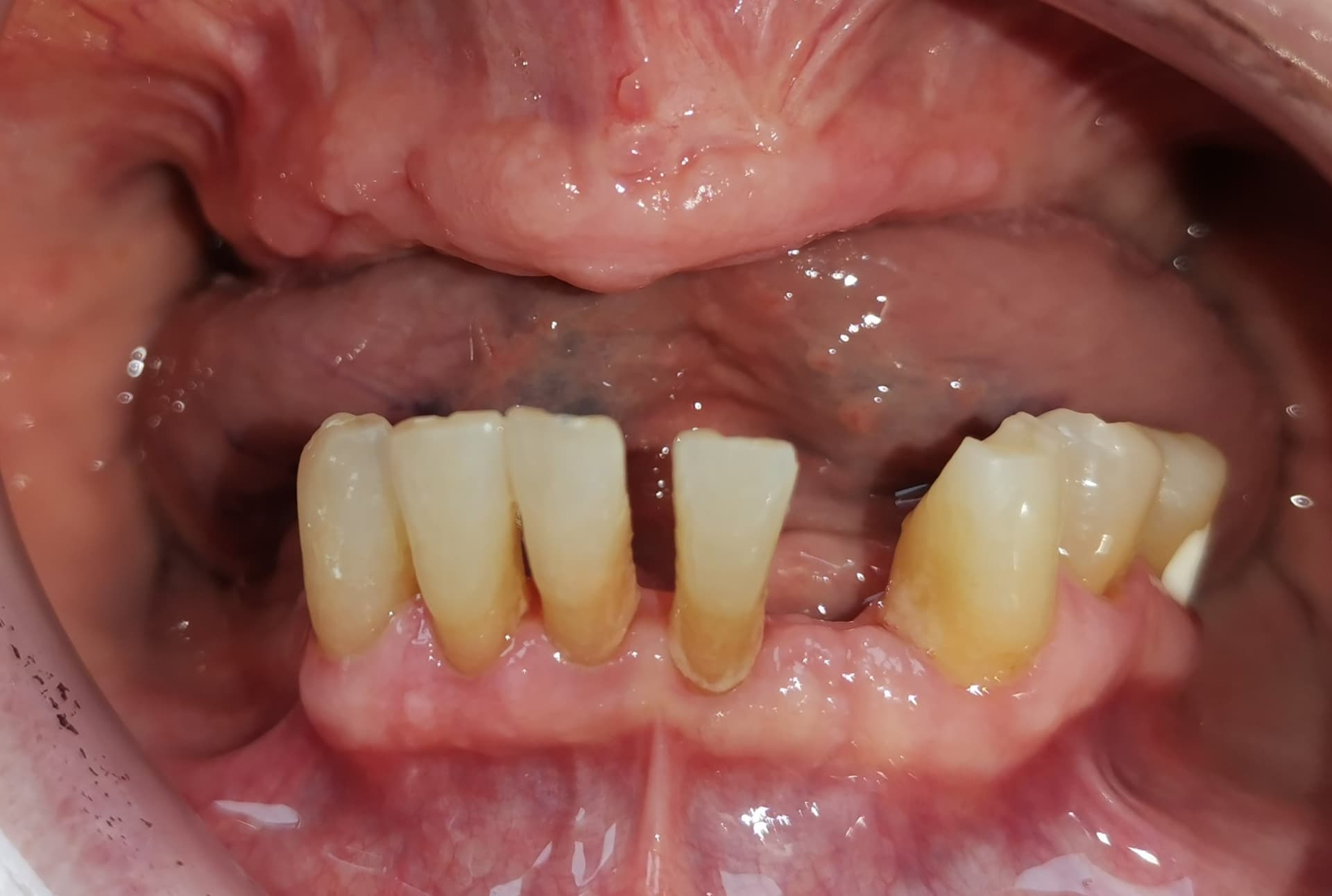 Reabilitare orală complexa prin All-on-6 maxilar și lucrări protetice — înainte de tratament stomatologic Bacău