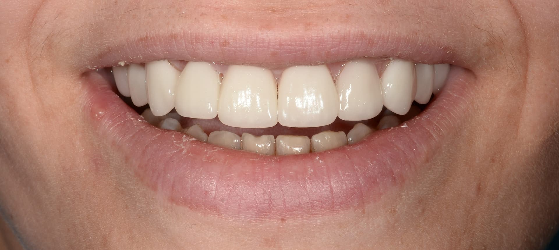 Estetică prin fațete ceramice — rezultat după tratament stomatologic Bacău