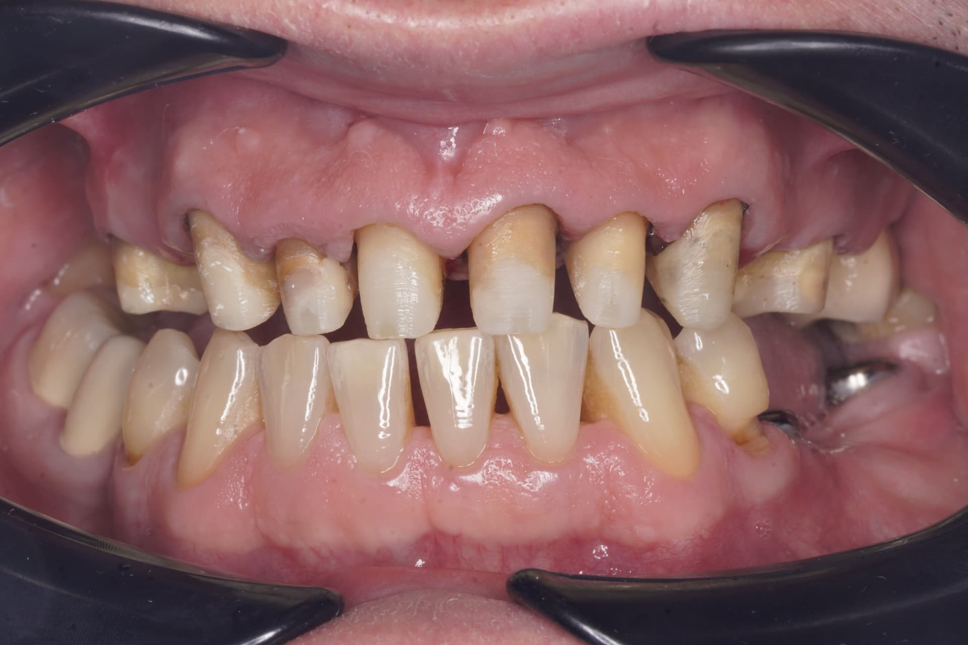 Reabilitare orală complexă — înainte de tratament stomatologic Bacău