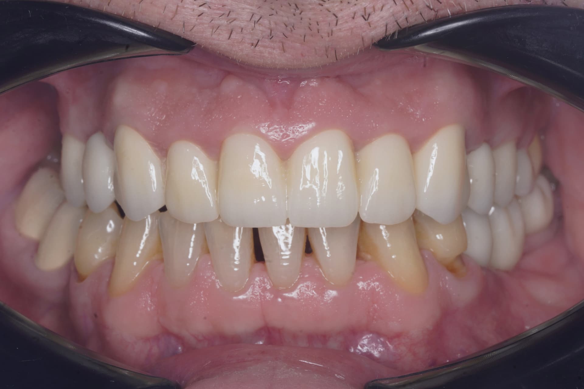 Reabilitare orală complexă — rezultat după tratament stomatologic Bacău