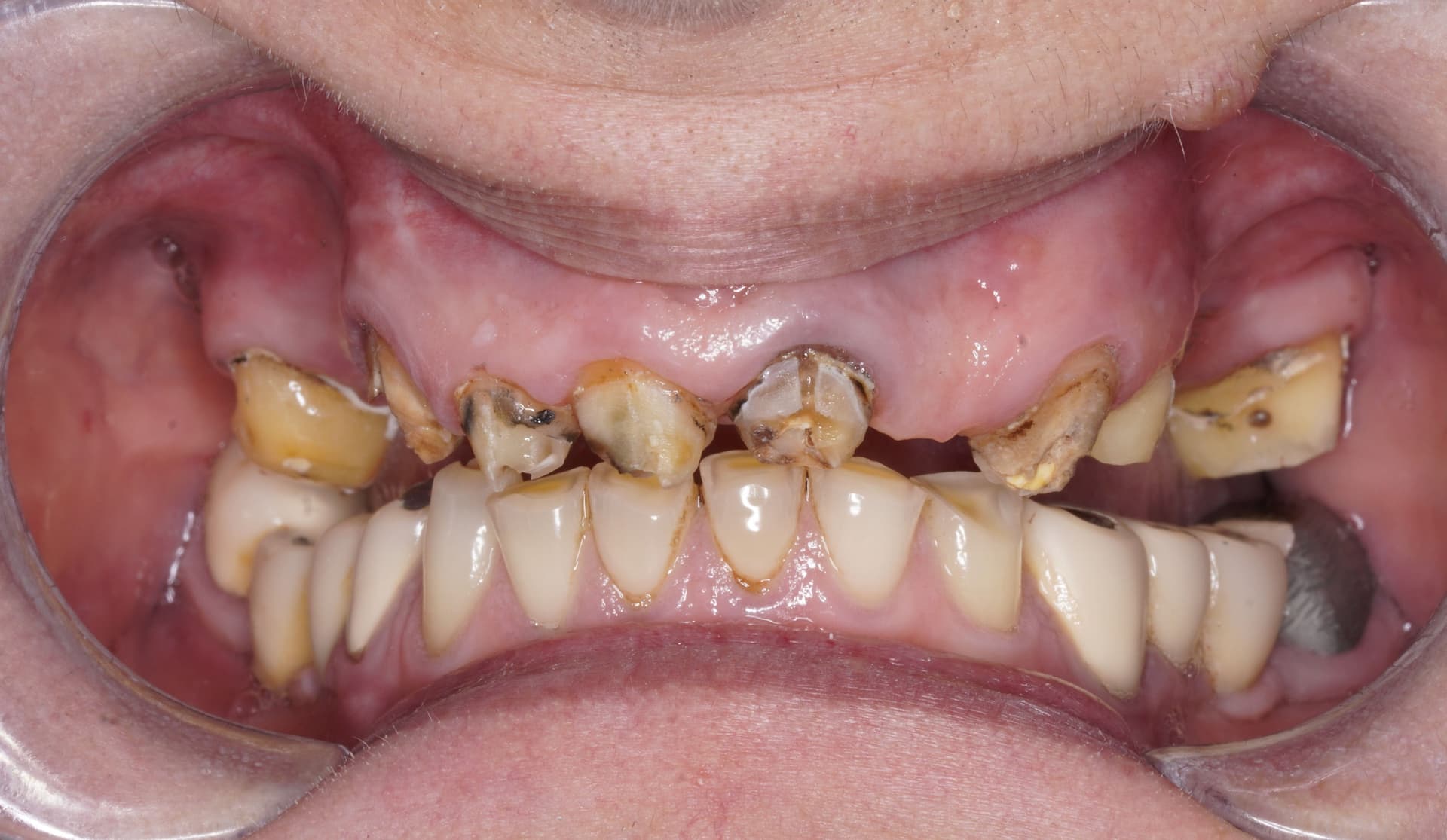 Reabilitare orală complexă de la zero — înainte de tratament stomatologic Bacău