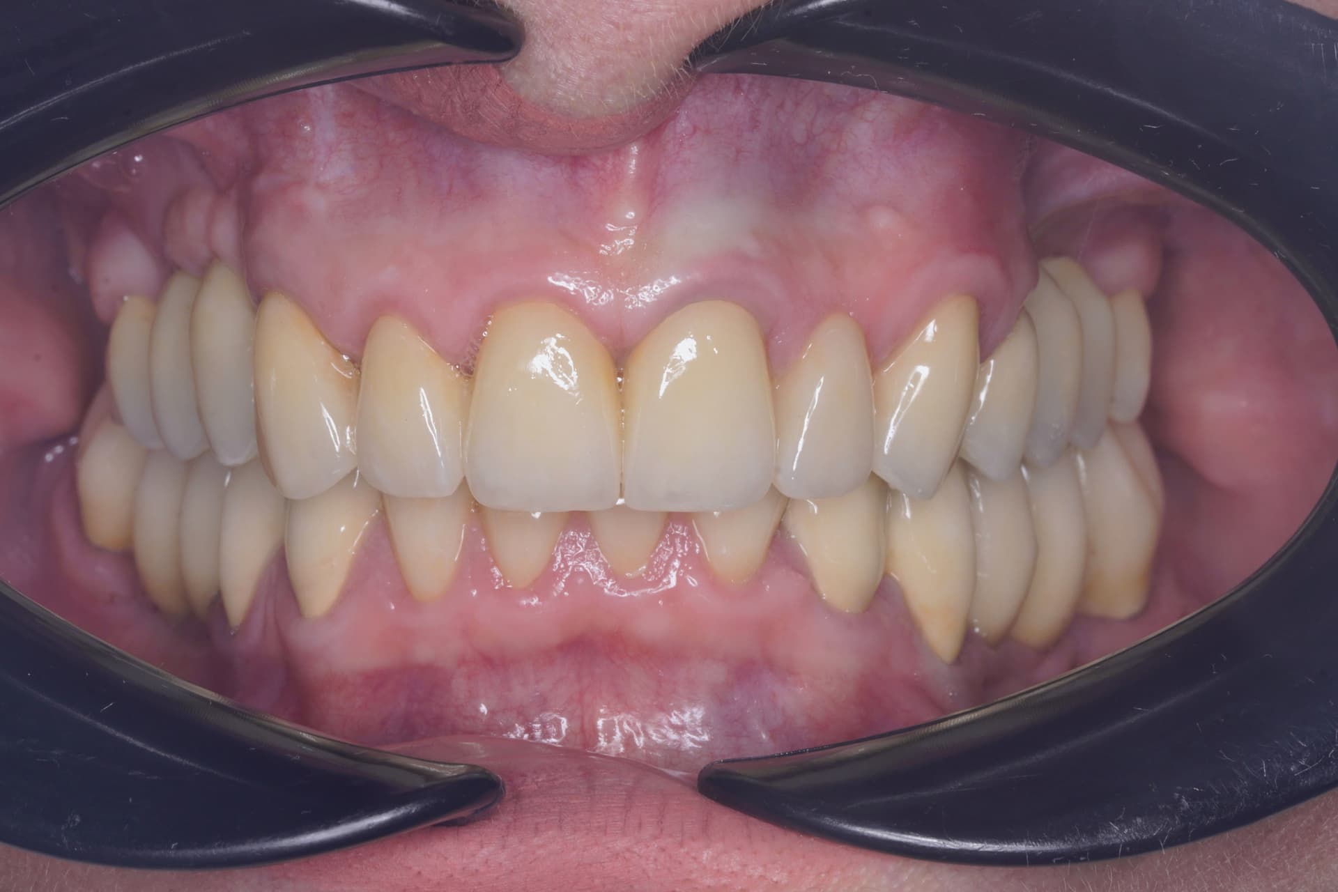 Reabilitare orală complexă de la zero — rezultat după tratament stomatologic Bacău