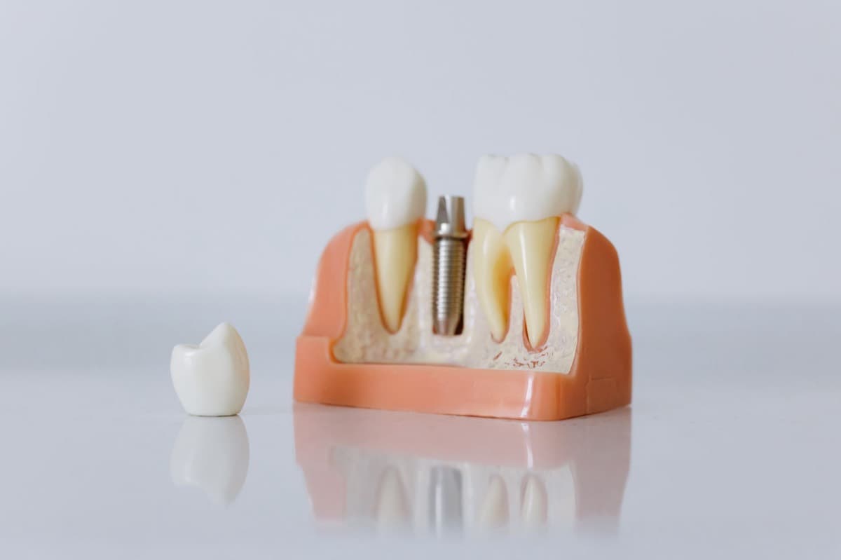 All-on-4 și All-on-6 Bacău — model de arcadă pe implanturi la Chromatic Dental Clinic