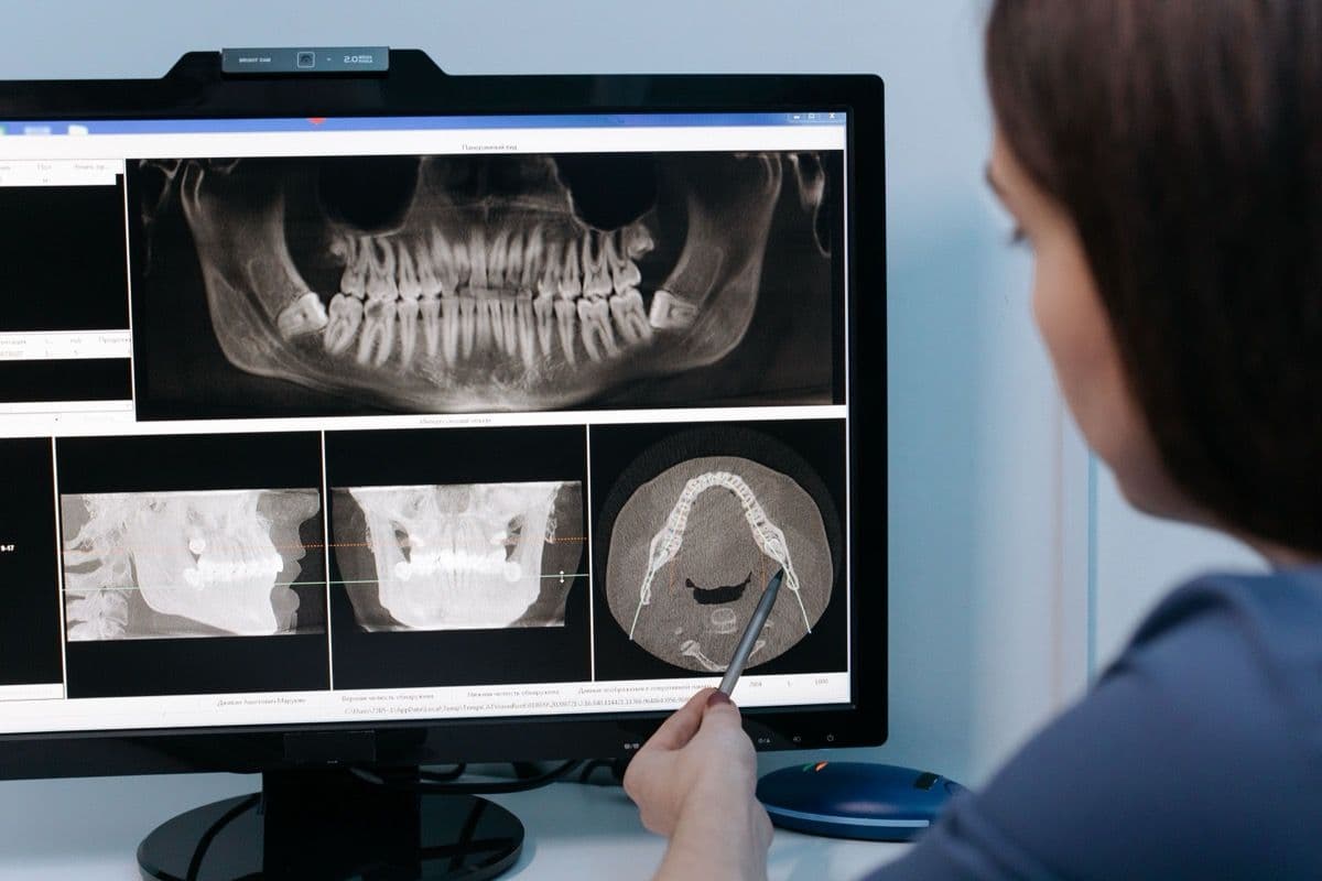 Medic stomatolog analizând CBCT-ul 3D pentru evaluarea osului înainte de sinus lifting în Bacău